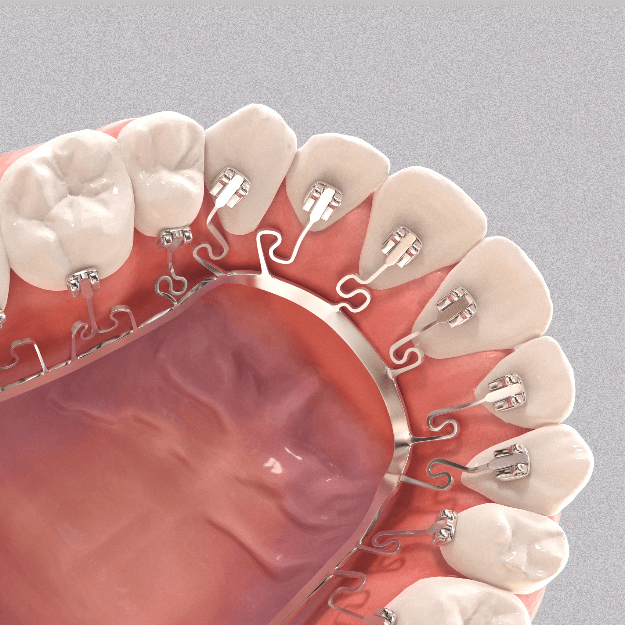 Braces behind the teeth - BRIUS braces
